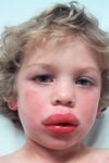 Анафилактический шок у детей – редкий вид аллергии 
