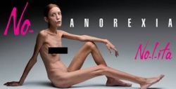 шокирующие случаи анорексии