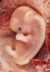 ранний поздний аборт