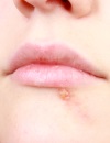 Герпес на губах – проблемы с иммунитетом 