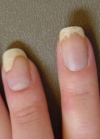 Псориаз ногтей – особенности лечения и ухода 