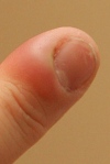 лечение ногтевого панариция