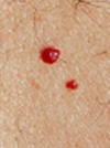 маленькие красные точки на теле укусы насекомых