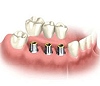 Восстановление зуба - какой способ самый безопасный? 
