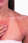 Лечение солнечных ожогов: спасаем «истерзанную» кожу 
