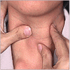 заболевания щитовидной железы 