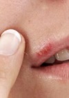 Как лечить простуду на губах – избавление от герпеса 