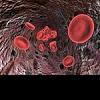 Пониженный гемоглобин - чем может грозить железодефицитная анемия
