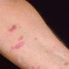 Заразен ли розовый лишай: виноват ослабленный иммунитет