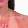 Лечение солнечных ожогов: спасаем «истерзанную» кожу