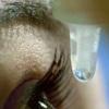 Дексаметазон: глазные капли – снимут аллергию, воспаление и отек глаз