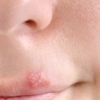 Мазь от простуды на губах – эффективные средства