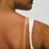 Лечим кожу от солнечных ожогов, чтобы избежать косметических дефектов